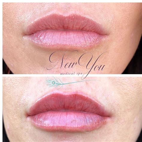 Pin On Lips Filler Injections Before And After