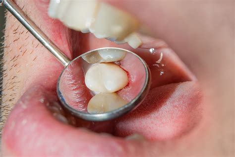 Protect Your Teeth With Dental Sealants Protective Dentistry