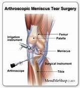 Medial Meniscus Tear Therapy Images