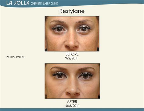 Patient Treated With Restylane At La Jolla Cosmetic Laser Clinic