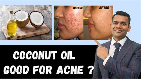 Is Coconut Oil Good For Acne Clear Glowing Skin At Home Youtube