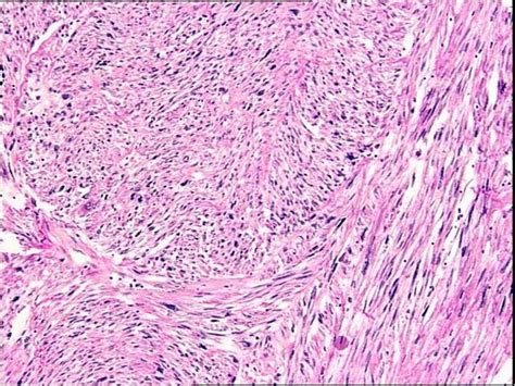 Pathology Outlines Leiomyosarcoma General