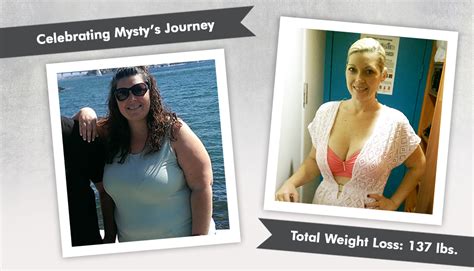 Before After Rny Gastric Bypass With Mysty Rny Gastric Bypass