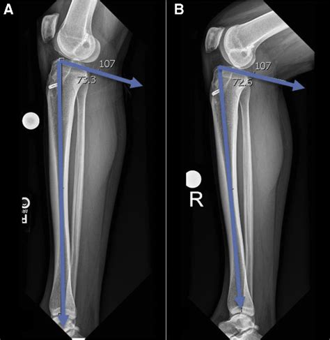 Figure 1 From Tibial Tubercle Preserving Anterior Closing Wedge