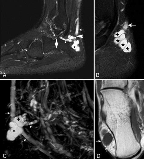 A Posttraumatic Joint Connected Sural Intraneural Ganglion Cyst—with A