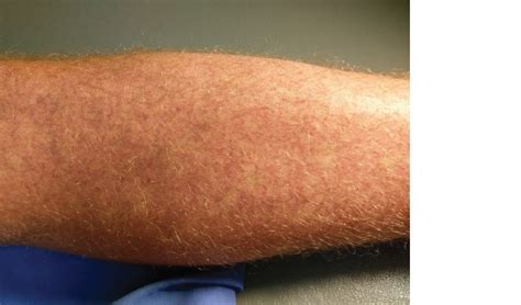 Racgp Rash In A Returned Traveller From Bali