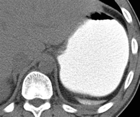 Spleen Radiology Key