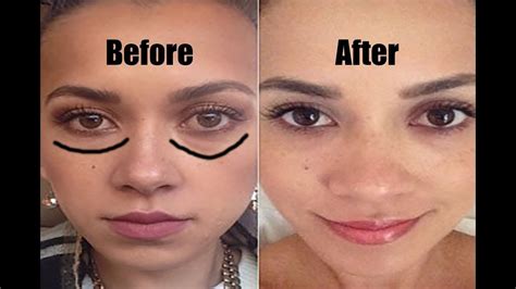 Get Rid Of Eye Bags Permanently In 1 Month Most Effective Ways To