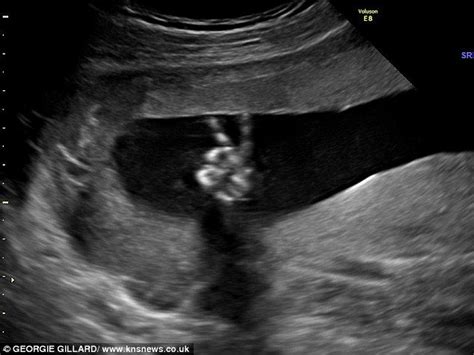 According To The Daily Mail At Ed And Dee Parsons 20 Week Ultrasound