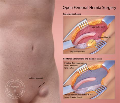Marzo Lesionarse Perth Blackborough Hernia Femoral Anatomia Semanal A O Permanentemente
