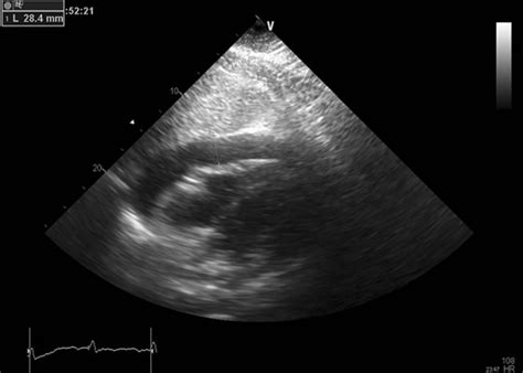 Transthoracic Echocardiography Subcostal View Showing Almost Cm