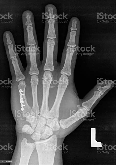 Radiografía De La Mano Izquierda Hueso Metacarpiano V Con Implante Foto
