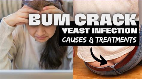 What Causes Yeast Infection On Bum Crack How To Get Rid Of It Youtube