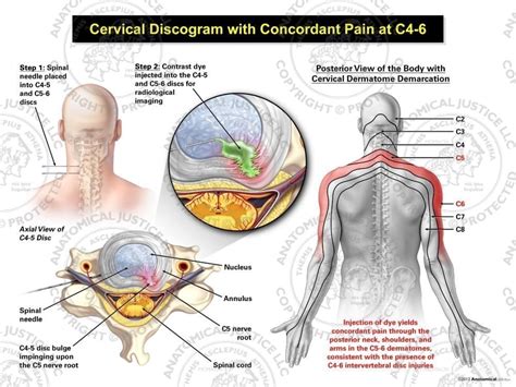 Male Left Cervical Discogram With Concordant Pain At C4 6