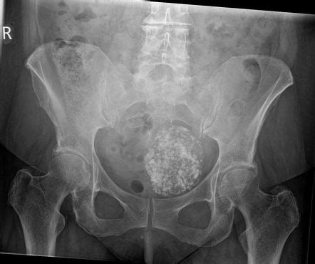 Calcified Uterine Fibroid Radiology Case Radiopaedia Org