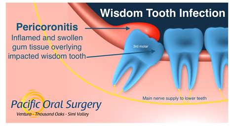 Wisdom Tooth Infection Pericoronitis In Ventura Ca Pacific Oral