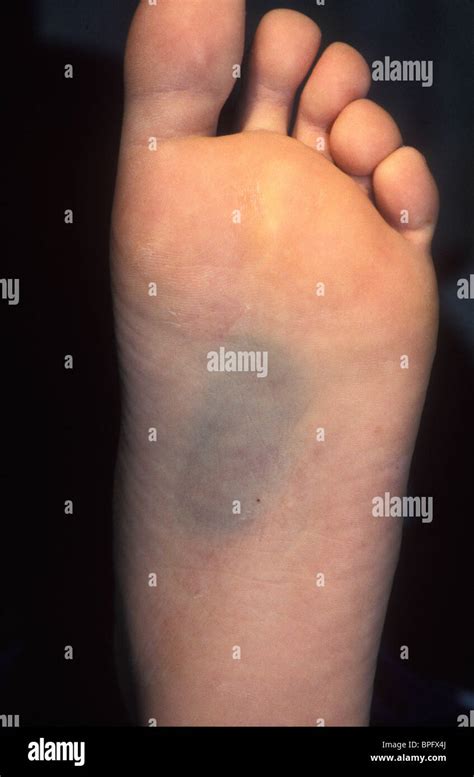 Bruise On The Sole Of The Foot As A Result Of A Calcaneal Fracture