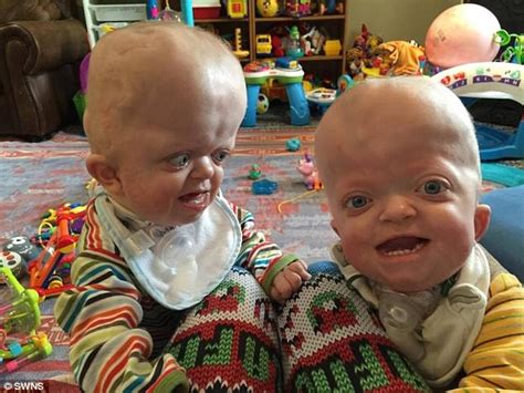 Minnesota Mom Adopts Twins With Rare Genetic Deformity Daily Mail Online