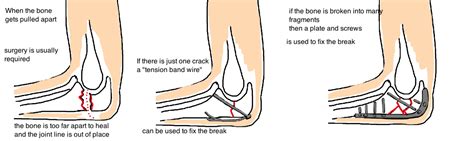 Broken Elbow Olecranon Fracture — Bone Talks