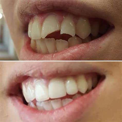 Broken Teeth Reconstruction Before And After Brucegate Dental Practice