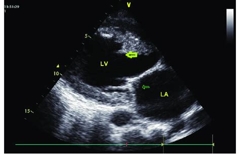 Transesophageal Echocardiogram Showing Vegetation On The Atrial Side Of