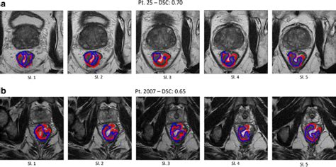 Mri Based Radiomics To Predict Response In Locally Advanced Rectal