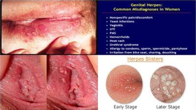 Webmd explains their symptoms and what you can do. Pin di Obat Herbal Herpes