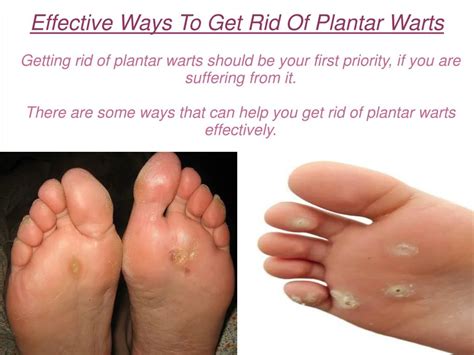 Ppt Effective Ways To Get Rid Of Plantar Warts Powerpoint Presentation Id7158395