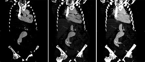 Preoperative Computed Tomography Ct Angiogram Shows Aortic Dissection