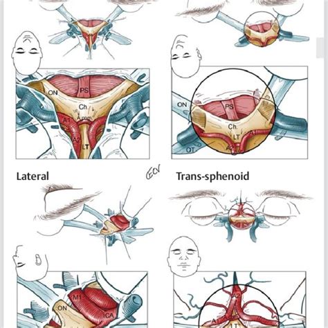 pdf trans lamina terminalis approach to third ventricle using supraorbital craniotomy