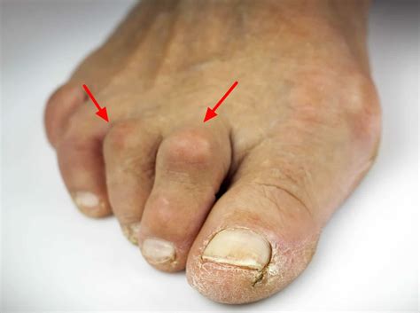 Hammer Toe Causes Appearance Symptoms And Hammer Toe Treatment