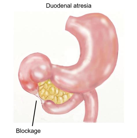 Duodenal Atresia Royal Manchester Childrens Hospital