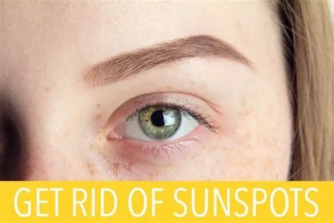 How To Get Rid Of Sunspots Advice Treatment And Side Effects