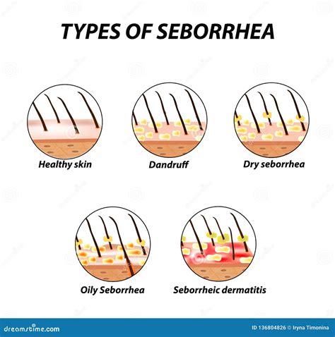 Types Seborrhea Seborrhea Skin Hair Dandruff Seborrheic Dermatitis
