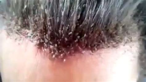 Video Emerges Online Of The Most Shocking Case Of Head Lice Ever