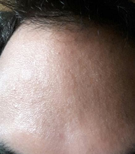 Small Red Bumps On Forehead Pictures Photos