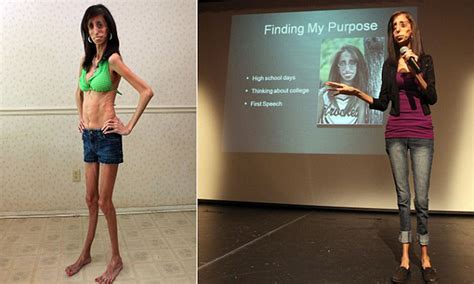 Lizzie Velasquez Body Measurement Bikini Bra Sizes Height Weight Celebrity Daftsex Hd