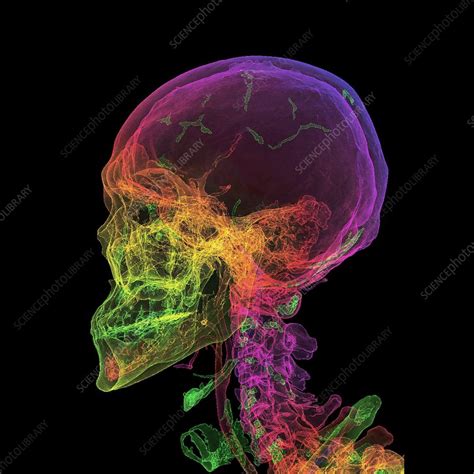Normal Human Skull 3d Ct Scan Stock Image C0295210 Science