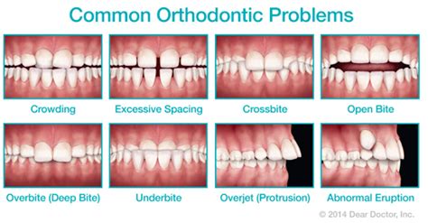Phase I Orthodontics In Carlsbad Ca The Brush Stop