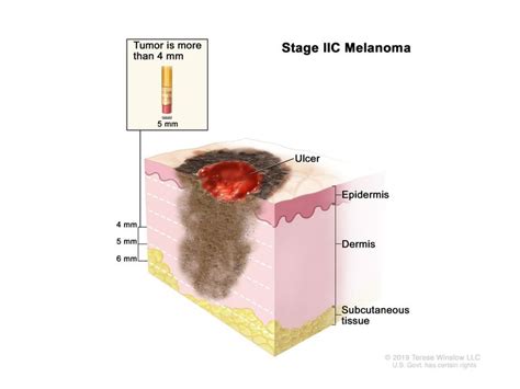 Stage Melanoma Treatment