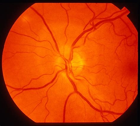 Enlarged Blind Spot Retina Image Bank