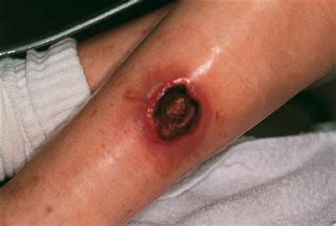 Brown Recluse Spider Bite Pictures Images And Photos Finder