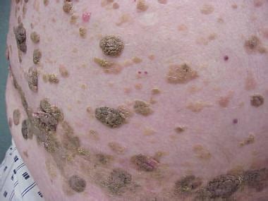 Know Your Lesions The Many Variations Of Seborrheic Keratosis My XXX