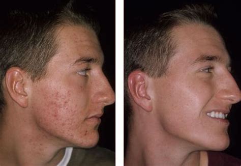 Acne Scars Removal Areton One Areton Limited