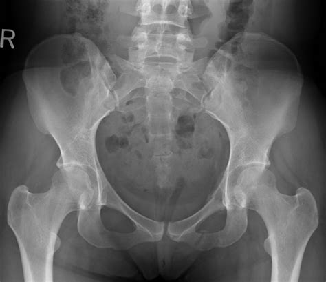 X Ray Of Normal Pelvis Female Eccles Health Sciences Library J