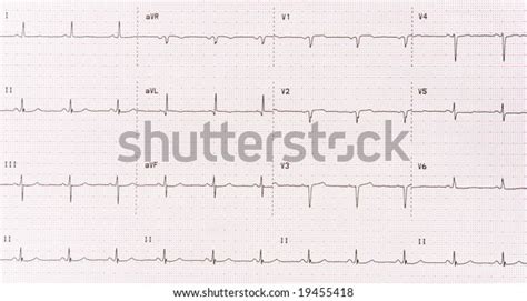 Twelve Lead Electrocardiogram Ekg Showing Patients Stockfoto 19455418