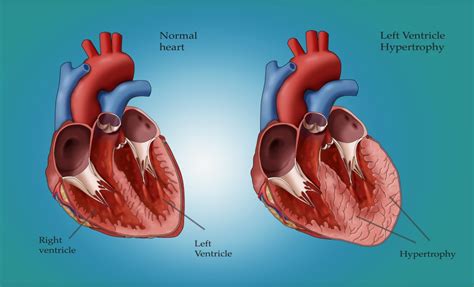 Left Ventricular Hypertrophy Lvh Also Known As An Enlarged Heart Is