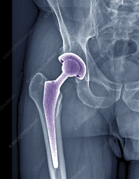 Total Hip Replacement X Ray Stock Image C0403284 Science Photo Library