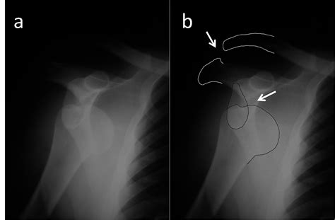 Cureus Simultaneous Anterior Glenohumeral Dislocation And Ipsilateral
