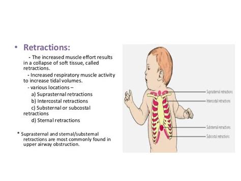 Intercostal Retractions In Respiratory Distress Syndrome Are Visible